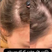 درمان تخصصی ریزش مو و رفع کم پشتی مو|خدمات آرایشگری و زیبایی|قم, صدوق|دیوار