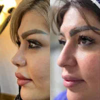 جشنواره ویژه عمل بینی