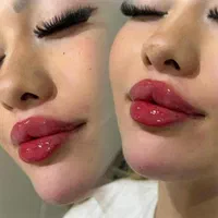 ژل لب چانه گونه بوتاکس فیلرآنزیم بینی لیزرهایفو|خدمات آرایشگری و زیبایی|مشهد, سجاد شهر|دیوار