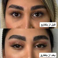 بلفارو روباهی در کلینیک مهرزاد|خدمات آرایشگری و زیبایی|تهران, جردن|دیوار