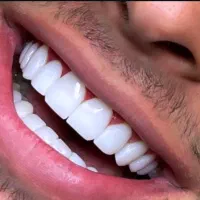 کامپوزیت هر فک فقط ۱۴۰۰۰ تومن اقساطی رشت و تهران