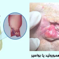 یبوست .شقاق.بواسیر