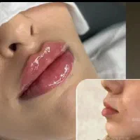 بوتاکس مصپورت فقط ۶۹۰تا اخر ماه