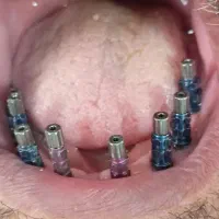 کاشت ایمپلنت یا کمترین درد متخصص فک صورت|خدمات آرایشگری و زیبایی|تهران, توحید|دیوار