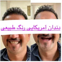 دندانسازی/دندان مصنوعی/ لمینتی / ضمانتی و چکی|خدمات آرایشگری و زیبایی|مشهد, عبادی|دیوار