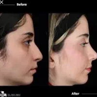 عمل جراحی بینی لیفت خدمات زیبایی با متد پیشرفته|خدمات آرایشگری و زیبایی|کرج, گلشهر|دیوار