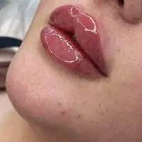 تخفیف ژل لب و صورت تخصصی