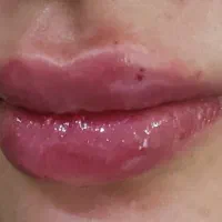 مدل ژل و بوتاکس و پوست و خدمات لیزر|خدمات زیبایی و سلامت|اصفهان, سعادتآباد|دیوار