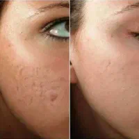 جشنواره تخفیف پی آر پی(PRP)/مزونیدلینگ مو و صورت|خدمات آرایشگری و زیبایی|اصفهان, جلفا|دیوار