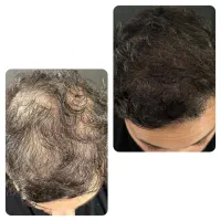 آموزش و خدمات میکرواسکالپ ،اسکراب ،مکمل کاشت مو|خدمات آرایشگری و زیبایی|مشهد, صیاد شیرازی|دیوار