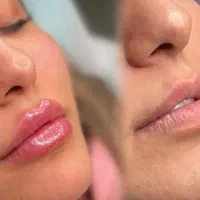 جشنواره ژل لب کانتورینگ مزوژل لیفت صورت