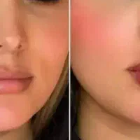 تزریق ژل  وآرایش دائمی