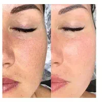 فیشیال.پاکسازی.مزو|خدمات آرایشگری و زیبایی|اهواز, کوی راه کربلا|دیوار