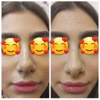 پلاسما پلکسر پلک و بینی و برداشتن خال|خدمات زیبایی و سلامت|کرمانشاه, |دیوار
