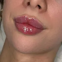 تزریق ژل لب بوتاکس لیفت نخ آنزیم کانتورینگ ساکشن|خدمات آرایشگری و زیبایی|تهران, صادقیه|دیوار
