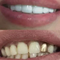 ساخت دندان مصنوعی متحرک فول دنچر|خدمات آرایشگری و زیبایی|لردگان, |دیوار