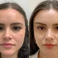 تخفیف پاییزی بوتاکس کلینیک زیبایی