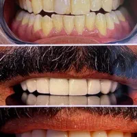 ایمپلنت ارتودنسی لمینت کامپوزیت|خدمات آرایشگری و زیبایی|مشهد, دوست آباد|دیوار