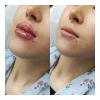 پاک کردن تتو.لیزرموهای زائد.ژل بوتاکس درجنوب تهران