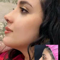 تخفیفات یلدا برای عملهای زیبایی