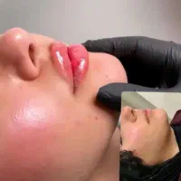 ژل و بوتاکس