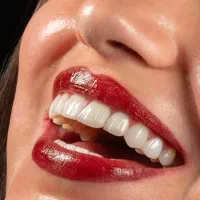 دندانپزشکی تبریز ایمپلنت  کامپوزیت عصبکشی  لمینیت