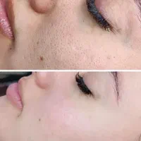 لیزر موهای زائد بانوان فول بادی  فقط ۲۹۹ مدت محدود