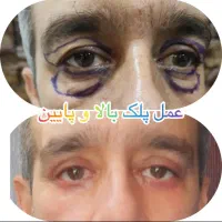 بلفارو پلاستی با تکینک ۲۰۲۶