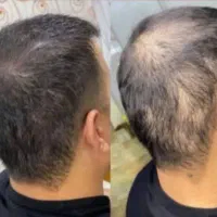 جایگزین کاشت ، رویش مجدد و کامل