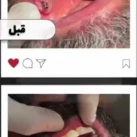 خدمات تخصصی ایمپلنت و اوردنچر|خدمات آرایشگری و زیبایی|اصفهان, کوی ولی عصر|دیوار