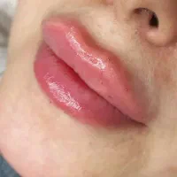 جشنواره ی تزریق بوتاکس و ژل و جوانسازها (هایفو،RF)