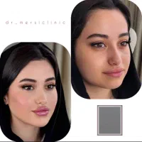 فوری فوری تخفیف٪۵۰ ژل بوتاکس برای شب یلدا