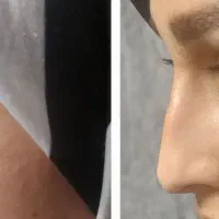 ژل بوتاکس فیلر زاویه ژل لب مطب پزشک|خدمات آرایشگری و زیبایی|قم, ارم|دیوار