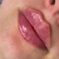 تزریق ژل و بوتاکس