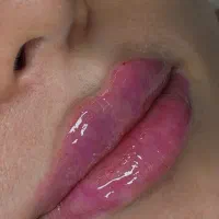 اموزش وتزریق  فیلر،بوتاکس،جوانساز(پرداخت اقساطی)