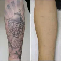 لیزر ونوس با دستگاه Soprano ICE Platinum|خدمات آرایشگری و زیبایی|تبریز, |دیوار