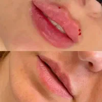 تزریق ژل و اصلاح فرم بینی مزوتراپی،آموزش اودری ۶۰۰