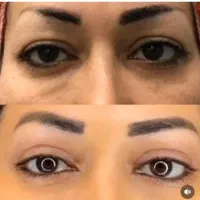 جراحی زیبایی پلک با قیمت مناسب|خدمات آرایشگری و زیبایی|تهران, نصرت|دیوار