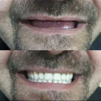 دندانسازی دندان سازی دندان مصنوعی پروتز|خدمات آرایشگری و زیبایی|مشهد, ولیعصر (شهرک غرب)|دیوار