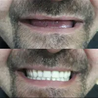 دندانسازی دندان سازی دندان مصنوعی پروتز|خدمات آرایشگری و زیبایی|مشهد, ولیعصر (امامیه)|دیوار