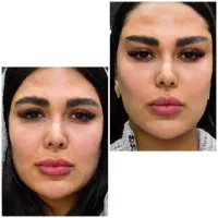 تزریق ژل لب بوتاکس مزو نخ آنزیم لیفت پکیج۱۰ سی سی|خدمات آرایشگری و زیبایی|تهران, مرزداران|دیوار