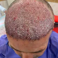 کاشت مو|خدمات آرایشگری و زیبایی|پارس‌آباد, |دیوار