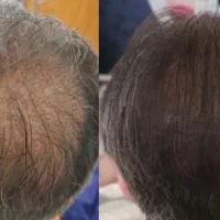 میکرواسکالپ یا تاپیک دائمی برای آقایان و بانوان