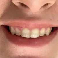 اقساط زیبایی ایمپلنت لمینیت کامپوزیت سجاد بهارستان|خدمات آرایشگری و زیبایی|مشهد, سجاد شهر|دیوار