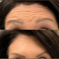 اموزش. بوتاکس فول فیس چشم گربه ای لیفت شقیقه|خدمات آرایشگری و زیبایی|خرم‌آباد, |دیوار