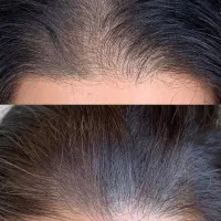مزو و کربوکسی مو برای رویش دوباره