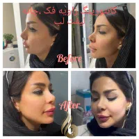 متقاضی مدل فیلر بوتاکس لیفت نخ