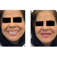 دندانپزشکی ،دندانسازی ،دندان مصنوعی،اوردنچر