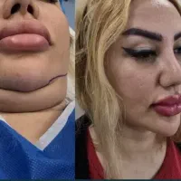 بلفارو و ساکشن غبغب و سانترال لب فقط۱۵میلیون