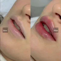 تخفیف ویژه فیلر بوتاکس prpمزو